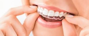 Invisalign in Komoka Ontario Komoka, ON